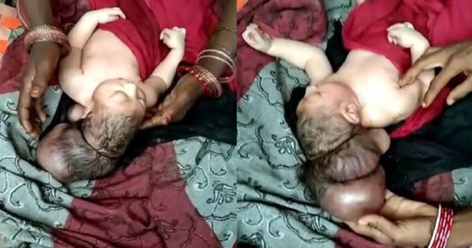 Three-headed baby hailed