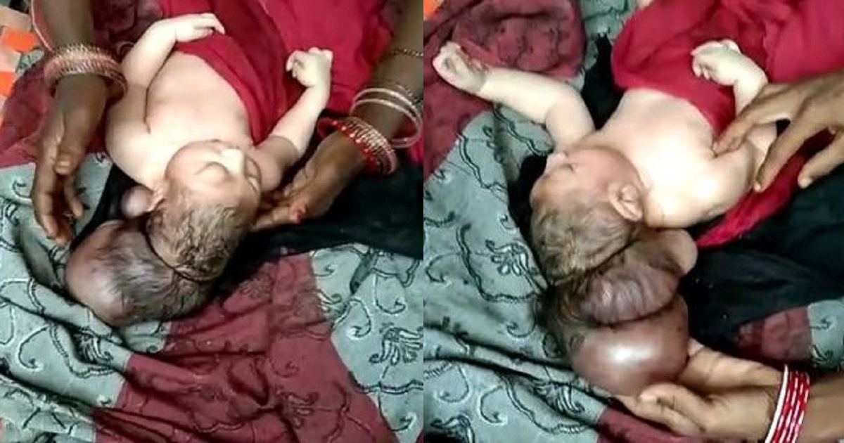 Three-headed baby hailed