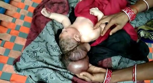 Three-headed baby hailed 