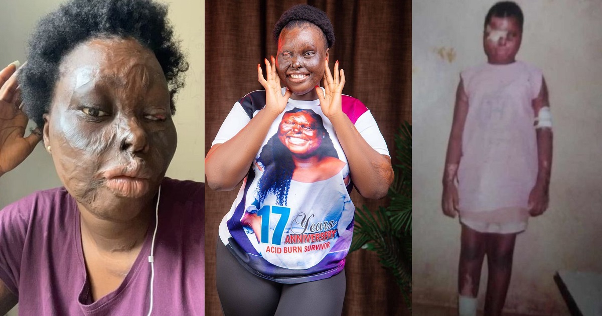 “This day took away my physical beauty but not who I am” – Burn survivor, Francess Obanye marks 17 years since she was attacked with acid by her uncle’s wife