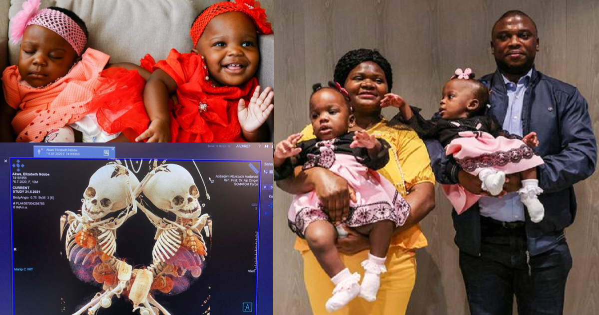 Conjoined twin babies successfully separated after intense 27-hour operation