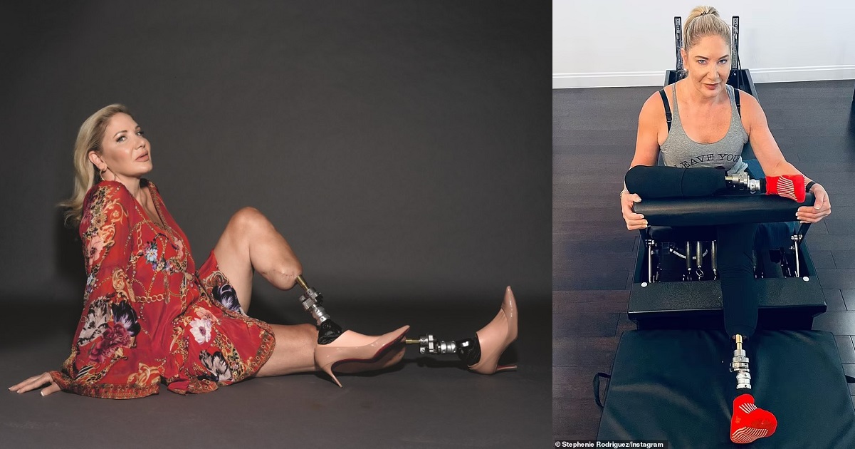 Australian socialite undergoes 36 surgeries and has both feet amputated after mosquito bite in Nigeria
