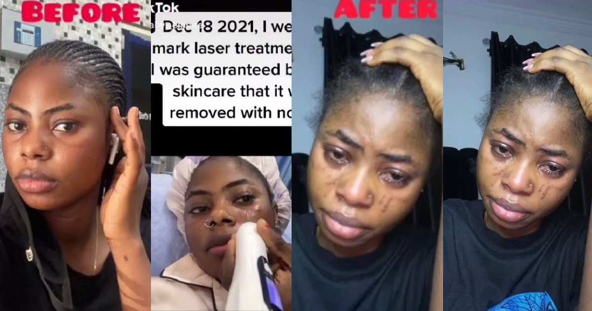 Nigerian lady laments bitterly after laser treatment she underwent to remove her tribal mark left her with more scars (video)