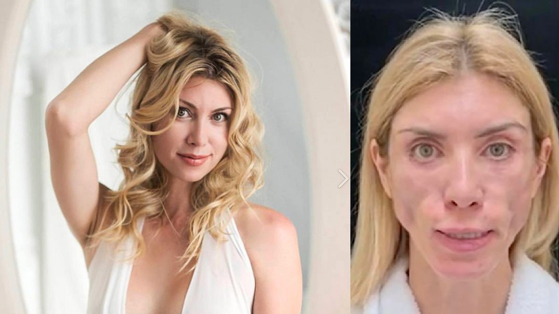 Beauty queen unable to smile and close eyes again after undergoing plastic surgery to look young