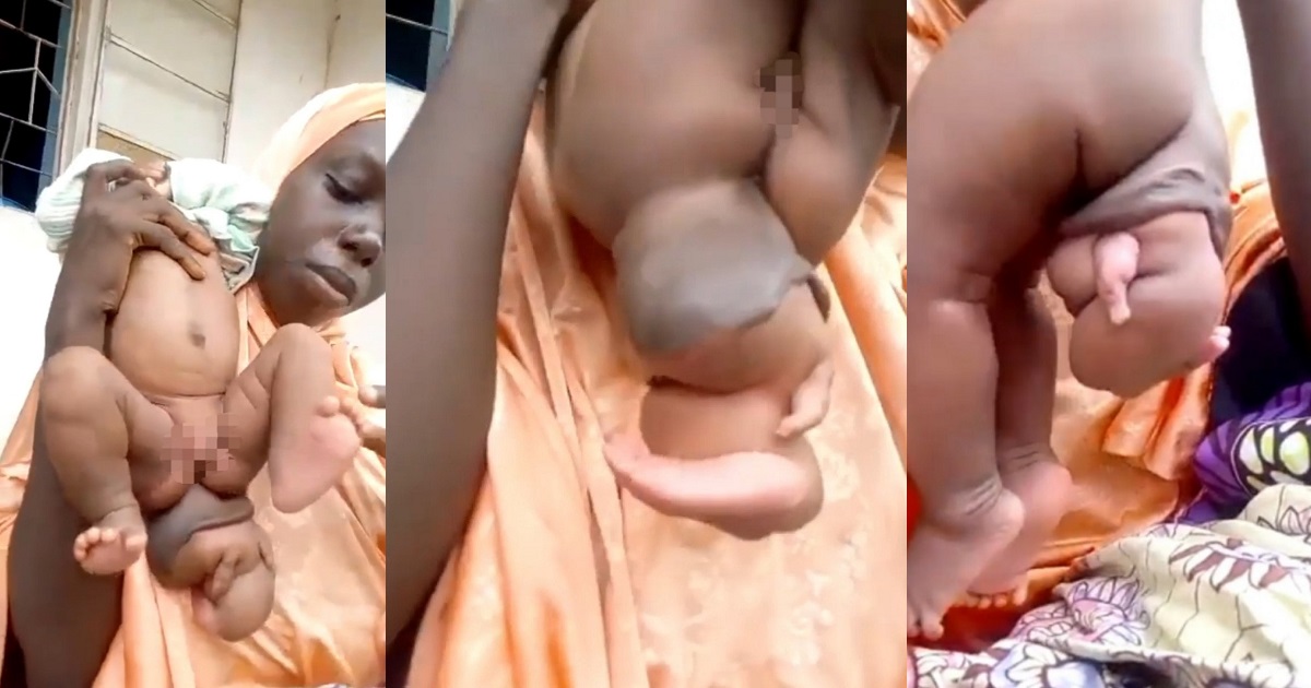 Baby born with her twin growing out of her butt (photos)