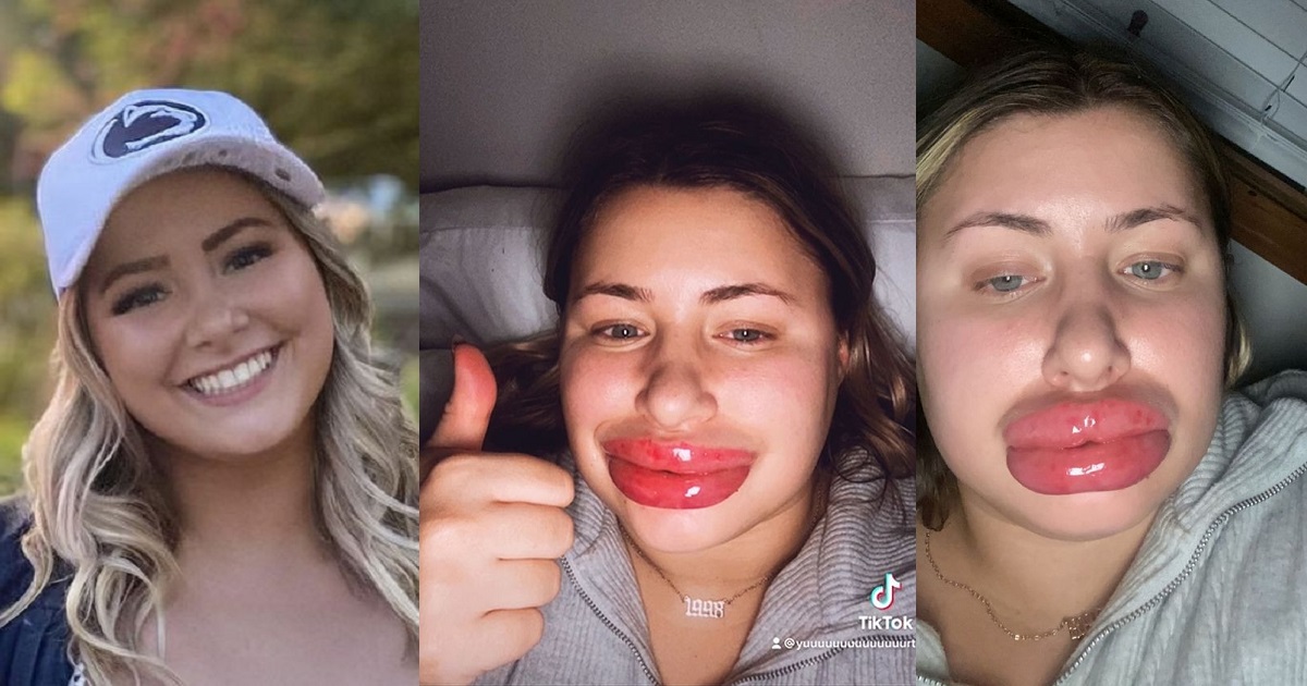 Woman's lips swells to 'eight times the normal size' after allergic