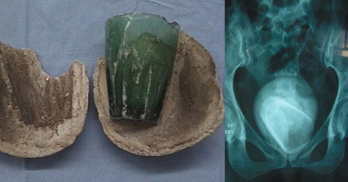 Doctors discover tumbler stuck in woman's bladder for 4 years after it