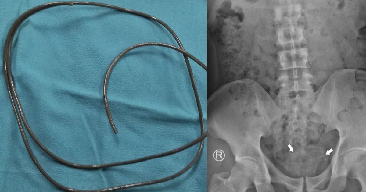 Man gets 80cm earphone wire stuck in bladder after using it while masturbating