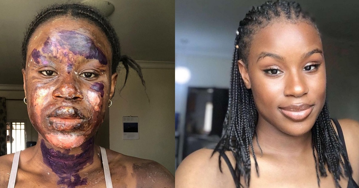 Burn survivor shows off her amazing transformation as skin heals without blemish (photos)