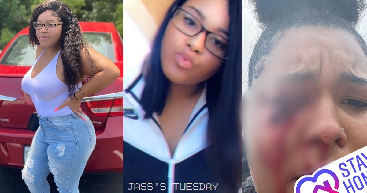 Lady loses right eye after her boyfriend of 3 years shot her