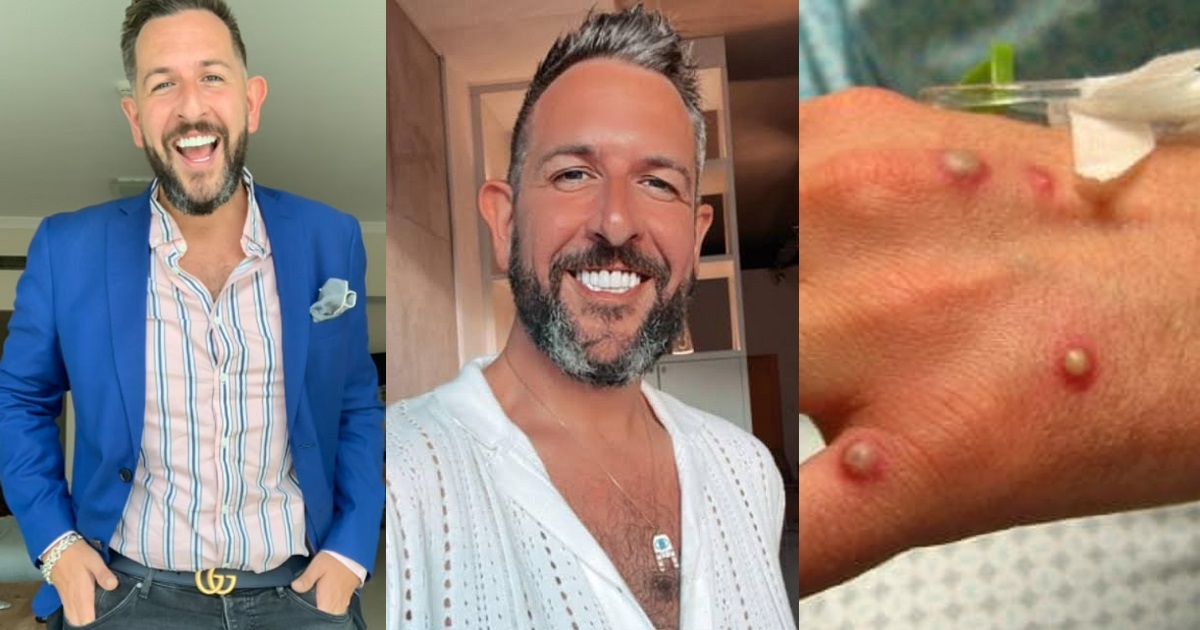 First monkeypox patient to go