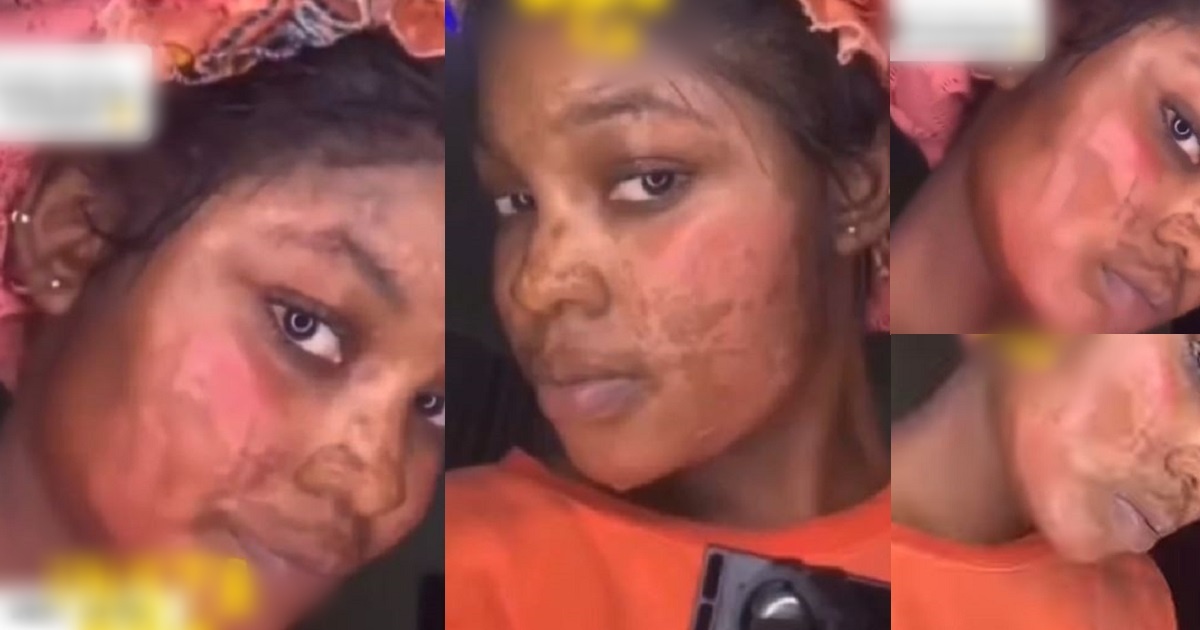 “My bestie bathed me with acid because her man was wooing me” – Lady claims (Video)