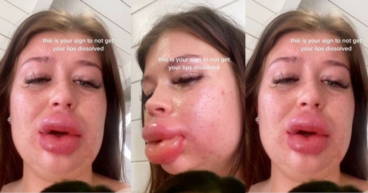 “This is your sign to not get your lips dissolved”  – Lady warns as severe reaction to filler dissolvent causes her lips to balloon