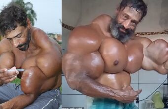 TikTok star who injected