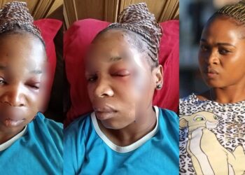 “This is the way I look now” – South African lady shows disfigured face after her baby daddy attacked her with bottle