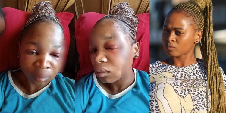 “This is the way I look now” – South African lady shows disfigured face after her baby daddy attacked her with bottle
