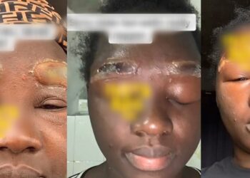 Botched microblading procedure leaves lady with severe eyebrow injuries (Video)