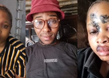 “He did this and got bail” – Lady calls out baby daddy who allegedly attacked her with bottle