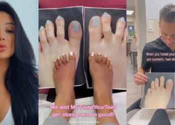 Pretty lady who didn’t like her long toes is mocked after getting toe-shortening surgery that looks worse (Video)