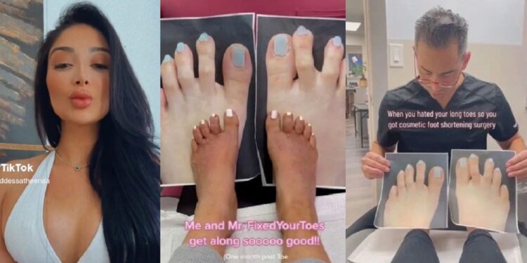 Pretty lady who didn’t like her long toes is mocked after getting toe-shortening surgery that looks worse (Video)