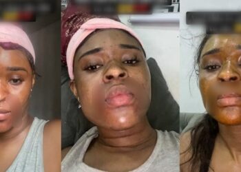 “What did I do to deserve this?” – Lady cries out after her mother’s househelp tried to disfigure her face (video)