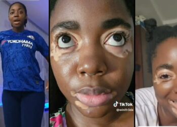 Lady shares how she got vitiligo after giving birth (video)