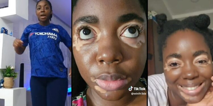 Lady shares how she got vitiligo after giving birth (video)