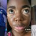 Lady shares how she got vitiligo after giving birth (video)