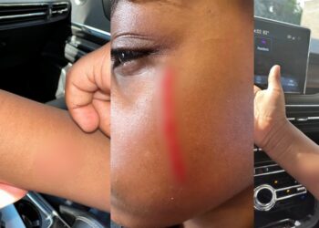 US-based Nigerian mother calls out school after her son was brutally attacked by his classmate (Graphic)