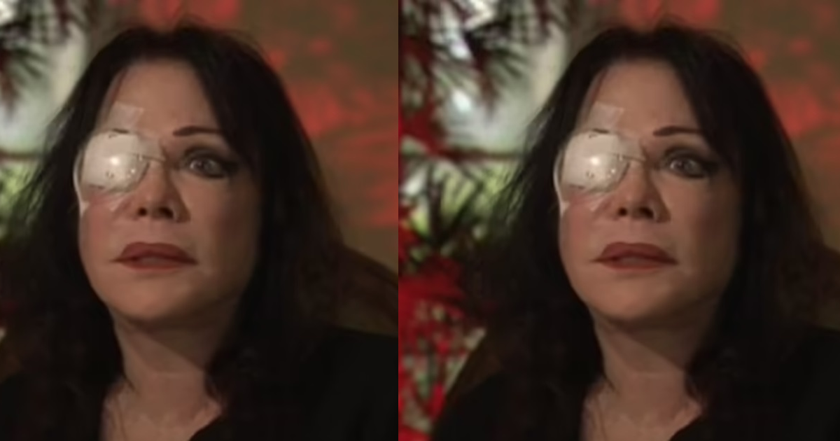 70-year-old woman left with one eye after undergoing facelift surgǝry