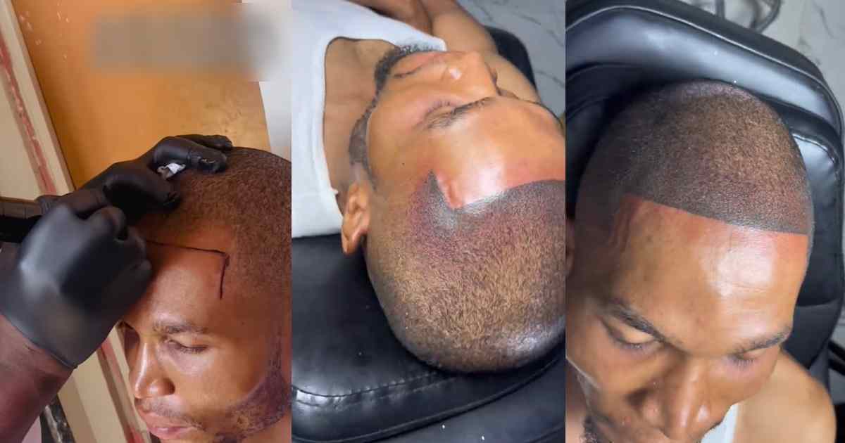 “What if he goes b@ld in old age?” – Man takes drast!c measure to define hairline, gets permanent tattoo (VIDEO)