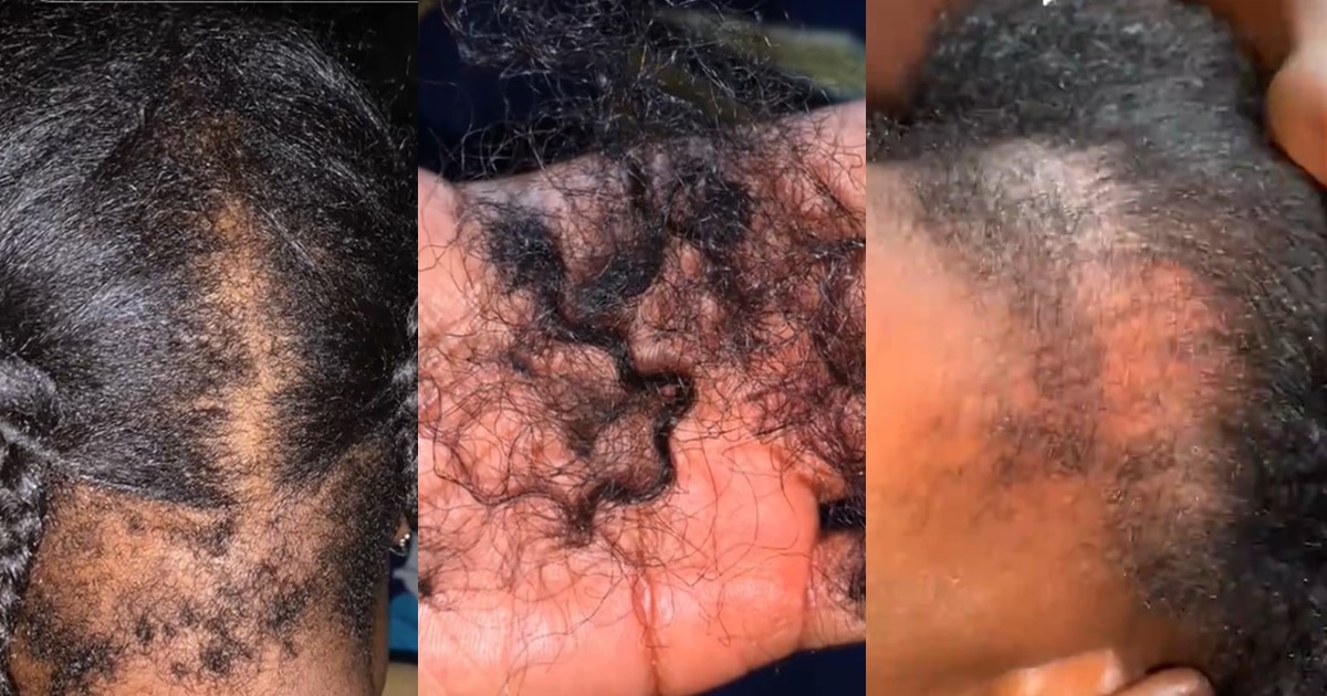 “My back hair is gone” – Lady l0ses hair after relaxing and braiding on the same day (WATCH)