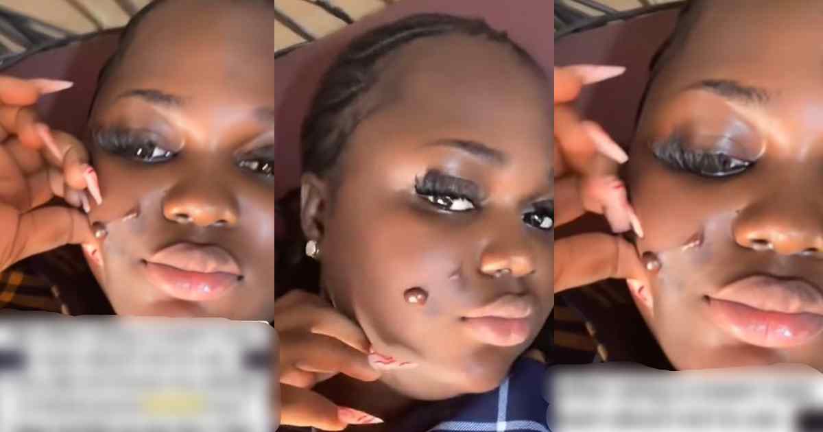“I have keloid on my face that has to be operated on” – Lady ign0res a skin care warn!ng, gets keloid infect!on on face (VIDEO)