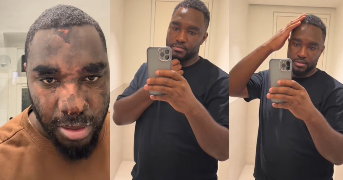 “13 months recovery” – Man shares remarkable facial recovery after surviving pressure cooker expl0sion (WATCH)