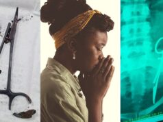 Lady discovers that a doctor forgot a scissors in her tummy for 12 years